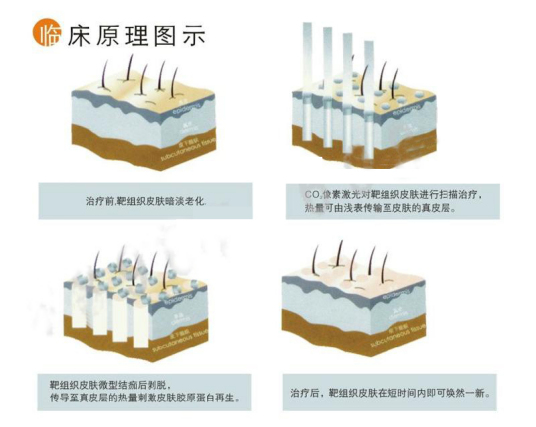 像素激光除皱