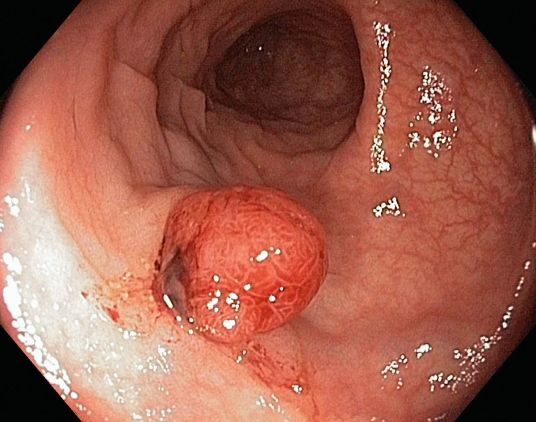 乙状结肠息肉