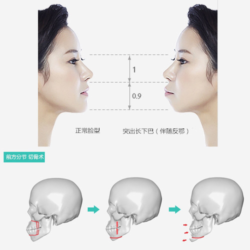 下巴矫正术