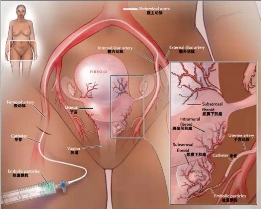 子宫肌瘤并发症