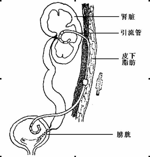 膀胱造瘘