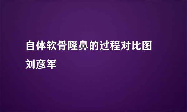 自体软骨隆鼻的过程对比图 刘彦军