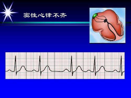 窦性心律不齐是怎么回事？