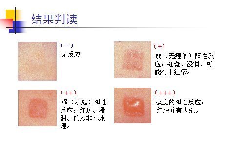 皮长是英加肤斑贴试验的试验步骤