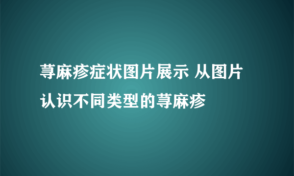 荨麻疹症状图片展示 从图片认识不同类型的荨麻疹