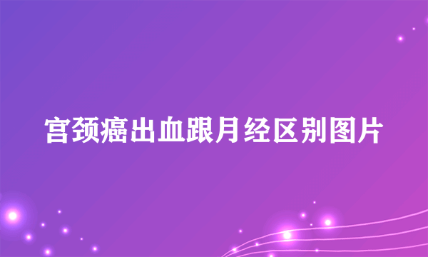 宫颈癌出血跟月经区别图片