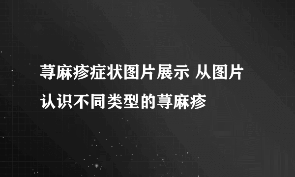 荨麻疹症状图片展示 从图片认识不同类型的荨麻疹