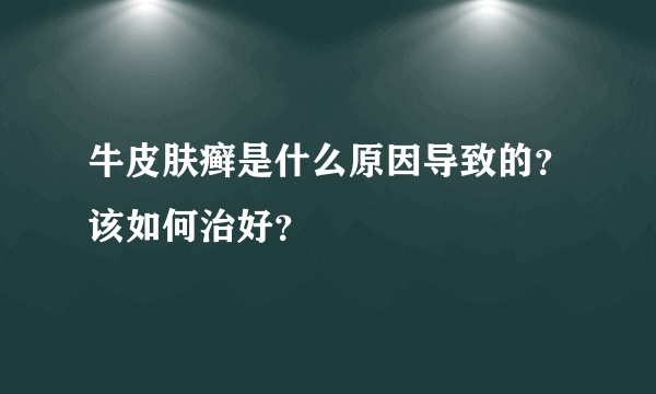 牛皮肤癣是什么原因导致的？该如何治好？