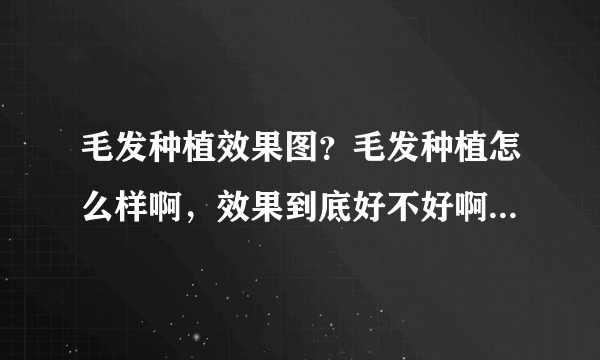 毛发种植效果图？毛发种植怎么样啊，效果到底好不好啊...