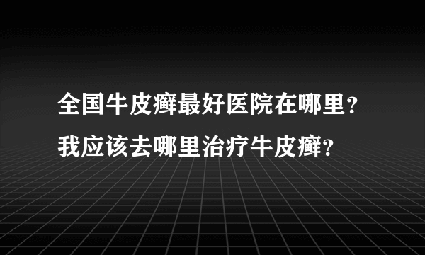 全国牛皮癣最好医院在哪里？我应该去哪里治疗牛皮癣？