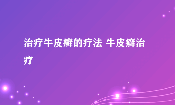 治疗牛皮癣的疗法 牛皮癣治疗