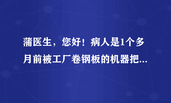 蒲医生，您好！病人是1个多月前被工厂卷钢板的机器把右...